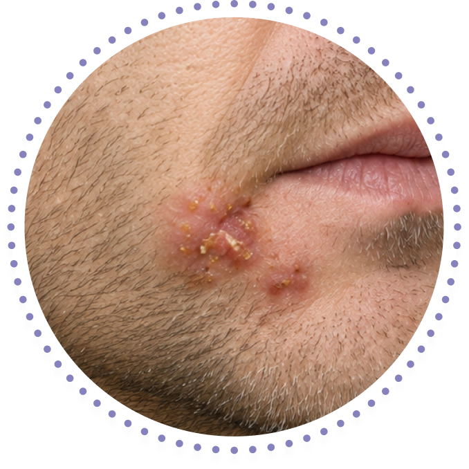 Close-up clinical photo of an HSV lesion near the mouth, illustrating lesion appearance (stock/clinical photo; not an actual patient).